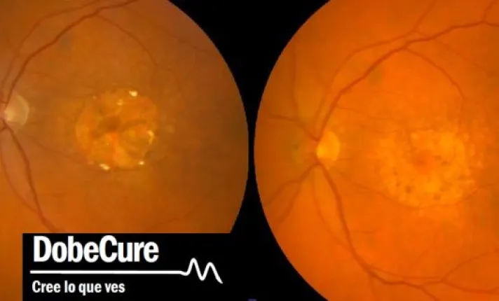 Resultados preliminares del ensayo de fase III de etamsilato para la degeneración molecular asociada demuestra eficacia