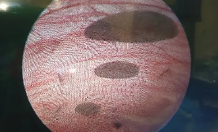 Placenta de oveja embarzada a la que se le han colocado 3 parches 