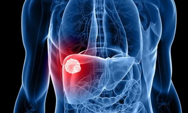 BCN HEALTH publica un estudio que pone de relieve los elevados costes sanitarios asociados al carcinoma hepatocelular en España