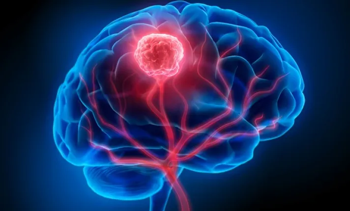 Imagen de un cerebro en el cual se puede identificar un tumor