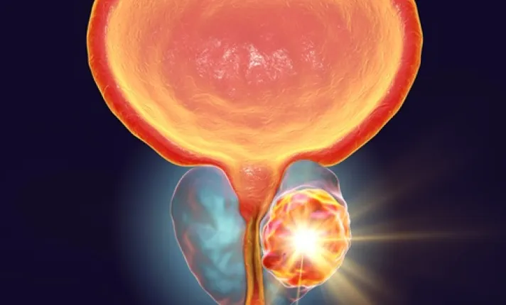 Imagen generada por inteligencia artificial de una próstata
