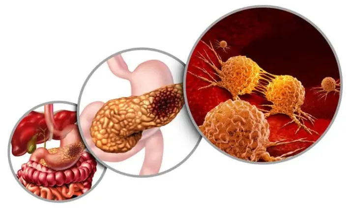 cancer_pancreas_asebio