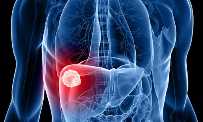 BCN HEALTH publica un estudio que evalúa la incidencia y el coste asociado al colangiocarcinoma intrahepático en España