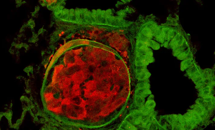Imagen de CNIO - células de cáncer de mama
