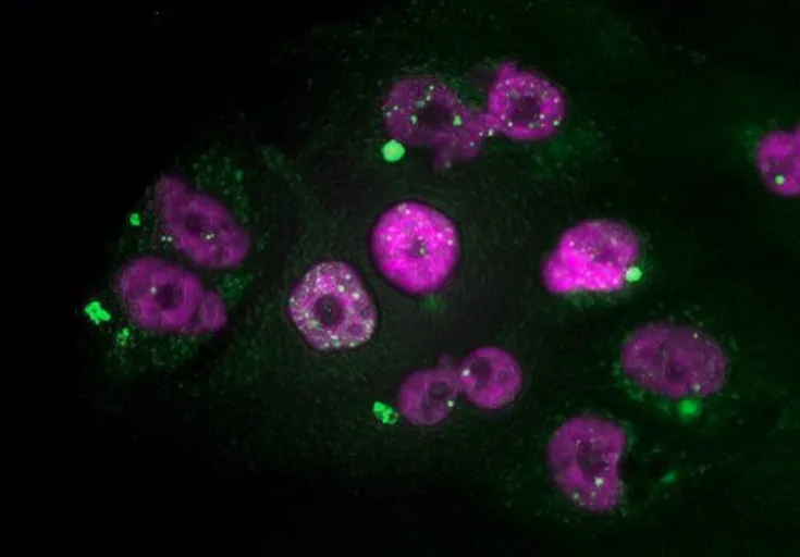 Adenocarcinoma ductal pancreas
