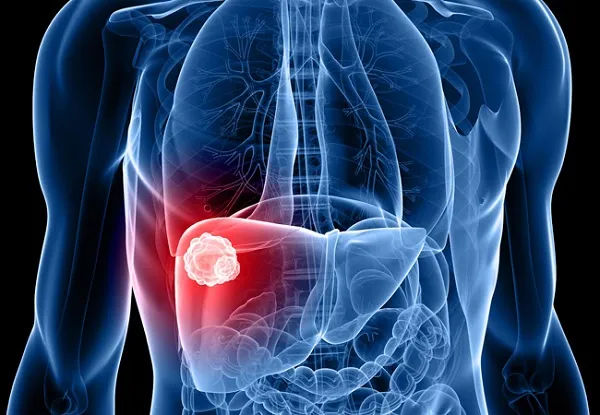 BCN HEALTH publica un estudio que evalúa la incidencia y el coste asociado al colangiocarcinoma intrahepático en España