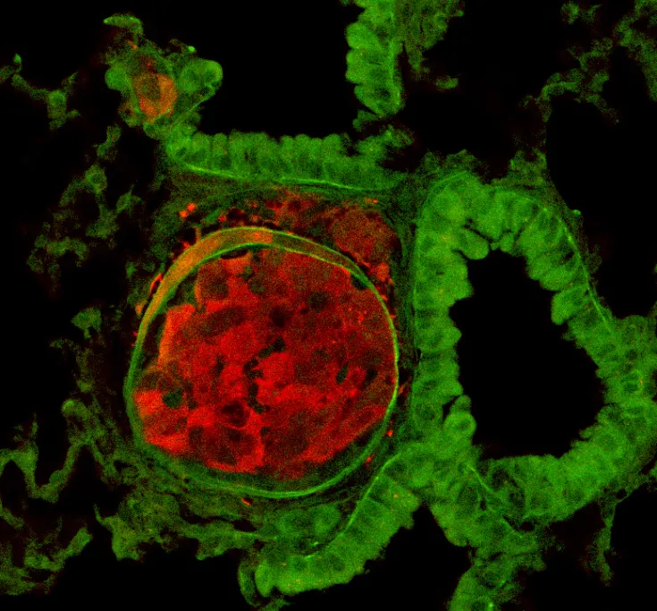 Imagen de CNIO - células de cáncer de mama