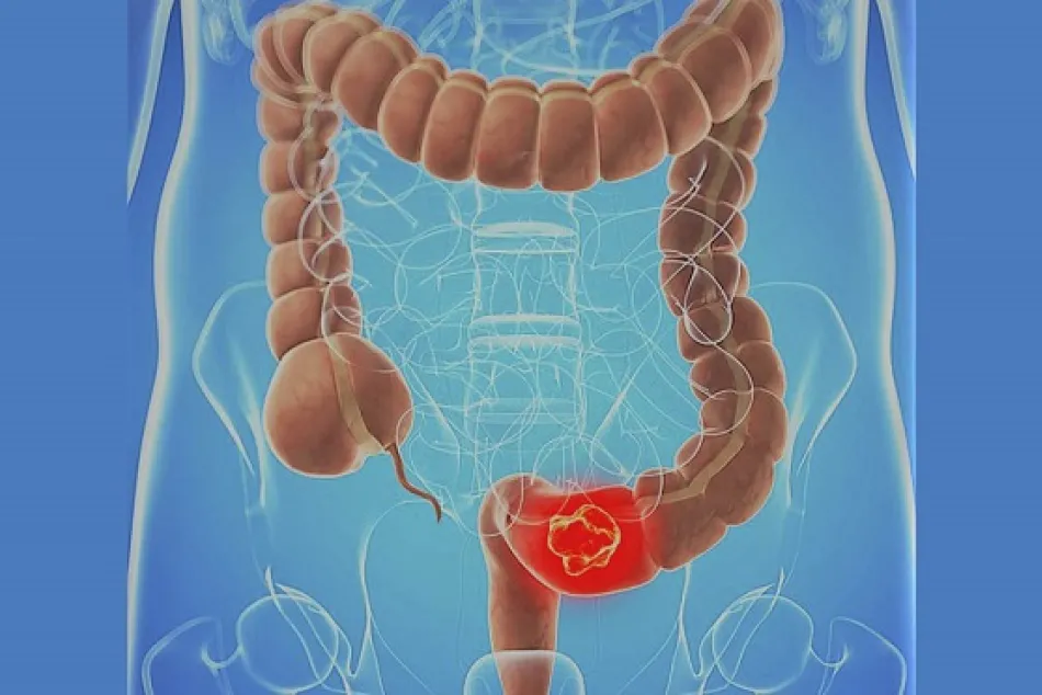 BCN HEALTH publica un estudio sobre los cambios en incidencia y mortalidad del cáncer colorrectal en España después de la implantación del cribado